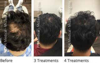 PRP Mens Hair Loss Treatment McLean VA