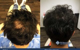 PRP Platelet Rich Plasma Treatment for Hair Loss