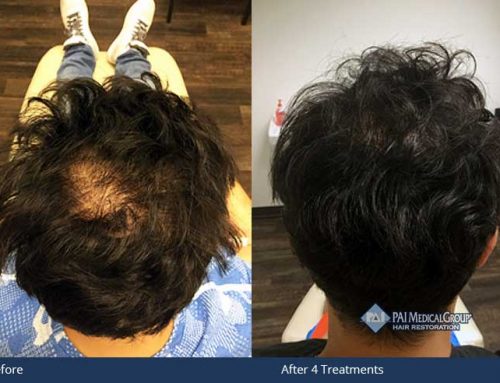 EPT Treatment for Hair Loss | Grow Your Hair Back™ Medical Virginia