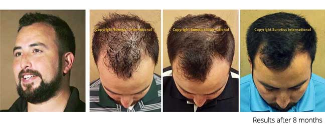 laser hair therapy results mclean virginia washington dc