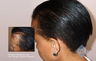 african american hair loss treatment traction alopecia washington dc