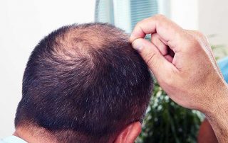 Telogen Effluvium Hair Loss - Grow Your Hair Back Hair Restoration Washington DC