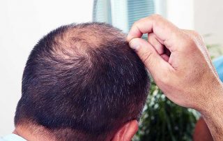 Telogen Effluvium Hair Loss - Virginia