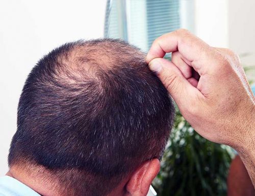 Your Receding Hairline: How Stress Can Make You Lose Your Hair