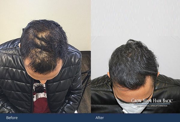 Laser PRP Hair Loss Treatment Washington DC McLean VA