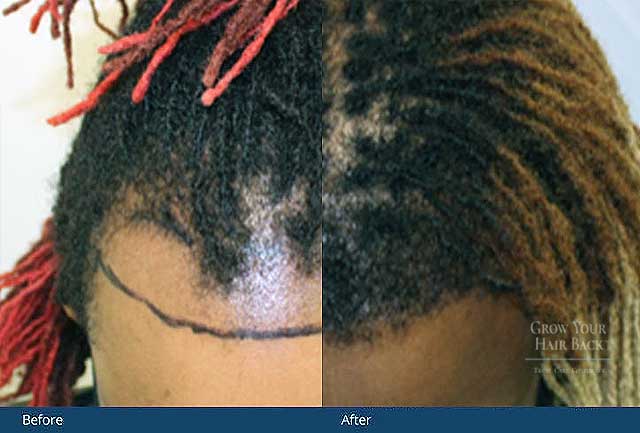 African-American hair transplantation results