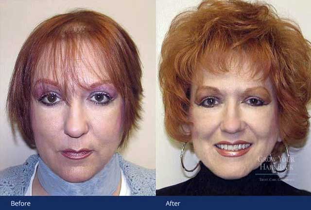 Women's hair transplant results
