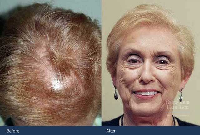 GYHB Female surgical hair restoration