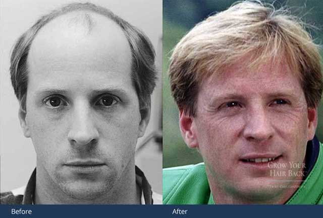 Multi-Unit Hair Grafting Transplant Results at GYHB