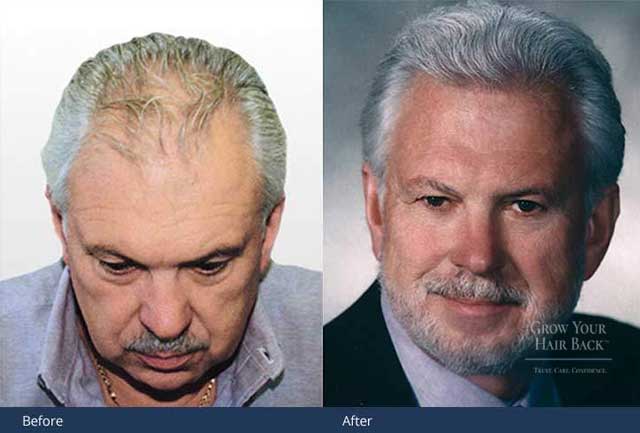 Men's surgical hair restoration results
