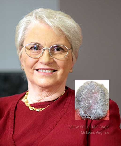 womens hair transplants mclean virginia
