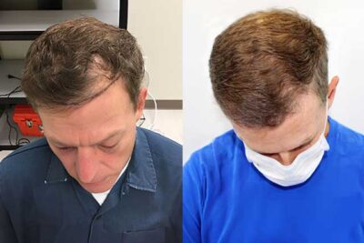 Grow Your Hair Back Hair Transplant Clinic Before After 02