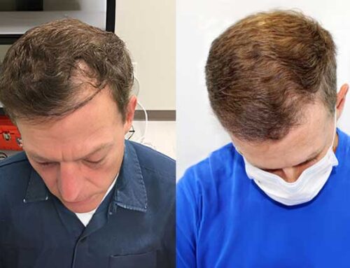 Botched Hair Transplant? Here’s How We Fix It