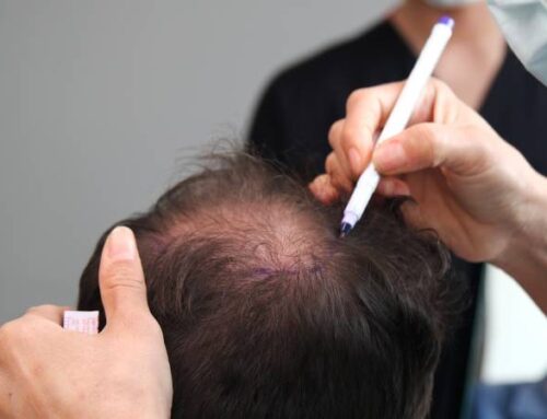 How Much Is a Hair Transplant in Northern VA?