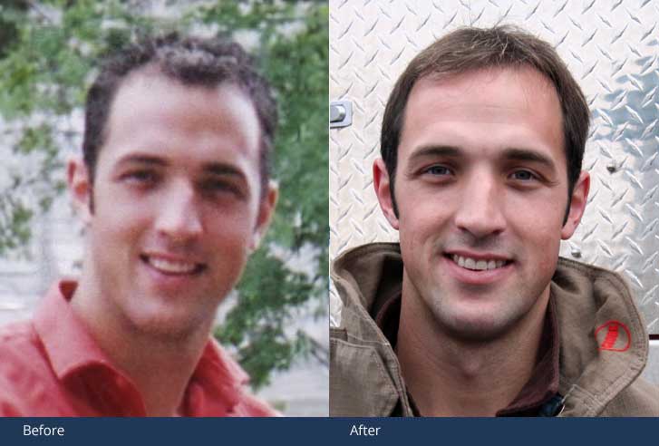 MUHG-Hair-Transplant-McLean-VA MUHG Hair Transplant McLean VA