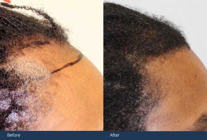 african-american-hair-transplant-mclean-va Grow Your Hair Back Hair Transplant Clinic Before After 04