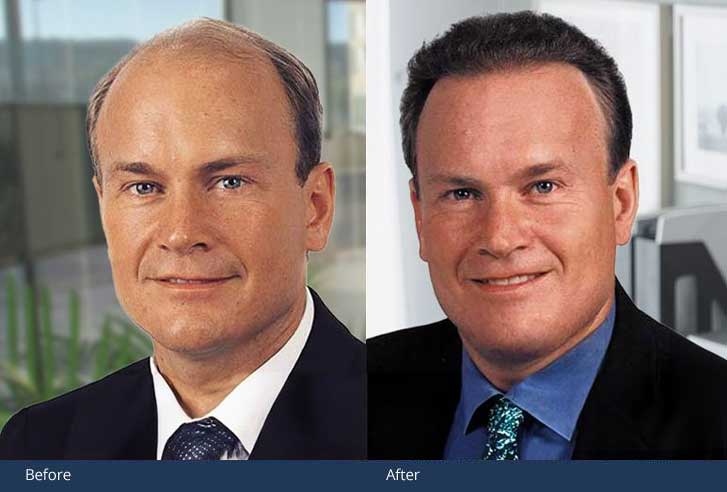 hair-transplant-mclean-va Grow Your Hair Back Hair Transplant Clinic Before After 04